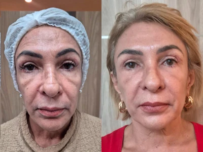 Bioestimulador de colágeno
