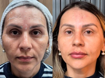 Microagulhamento com PDRN e skinbooster