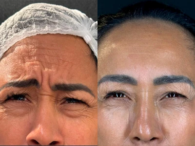 Aplicação de botox