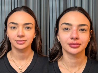 Preenchimento labial e facial