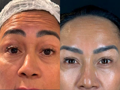 Procedimento de harmonização facial