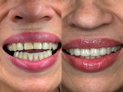 Estética dentária — facetas em resina